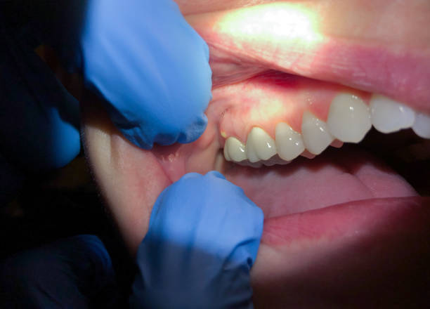 Best Emergency Wisdom Tooth Extraction in Landis, NC